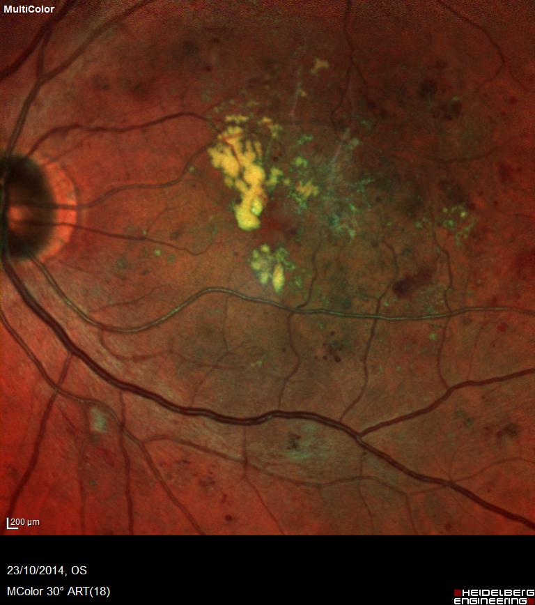 Lipid fat in the central macular